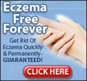 eczema free forever book
